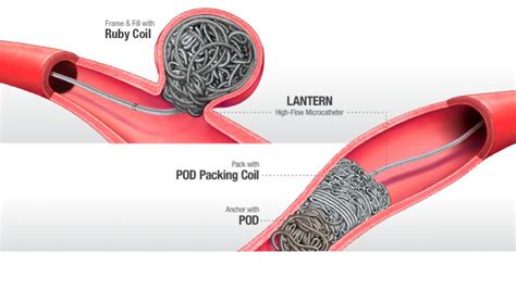 Embolisation System Vascupedia