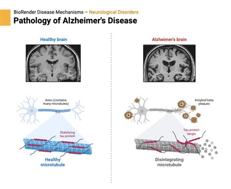 Pathology Of Alzheimer S Disease 2 BioRender Science Templates