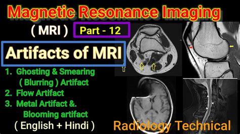 Mri Part Artifacts Of Mri Ghosting Smearing Artifact Flow