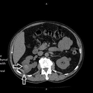 Case 4 63 YO Male Patient After Cyst Aspiration The Right Renal