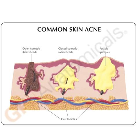 Acne Anatomy Anatomy Diagram Book | Images and Photos finder