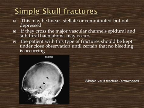 Simple Skull Fracture