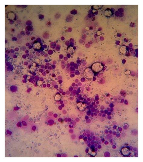 A Leishman Staining Of Bone Marrow Smear Showing Densely Packed