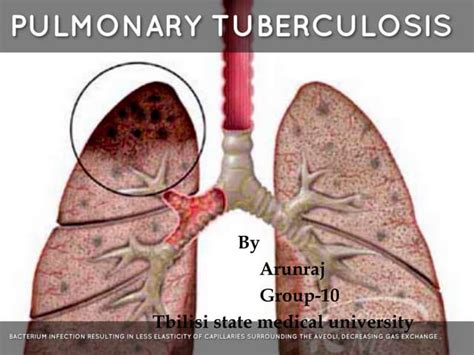 Pulmonary tuberculosis | PPT