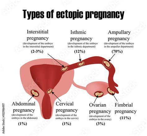 Types Of Ectopic Pregnancy Infographics Vector Illustration On