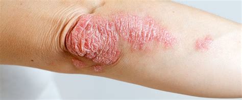 Psoriasis: A Comprehensive Overview of Causes, Symptoms, and Treatments