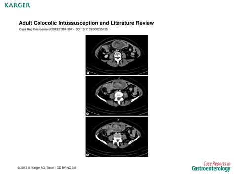 Adult Colocolic Intussusception And Literature Review Ppt Download