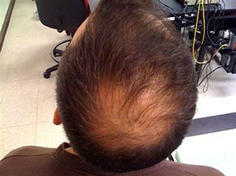 NATURAL HAIR LOSS TREATMENTS ARE BEST FOR ANDROGENETIC ALOPECIA - Body4Real