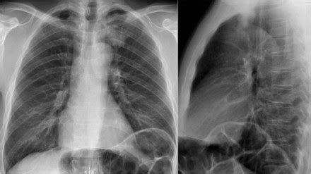 Chest Medicine Made Easy Dr Deepu Basics Of Chest X Ray Part