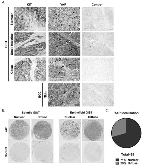 Yap Expression In Human Gist Primary Tumors A Immunohistochemistry