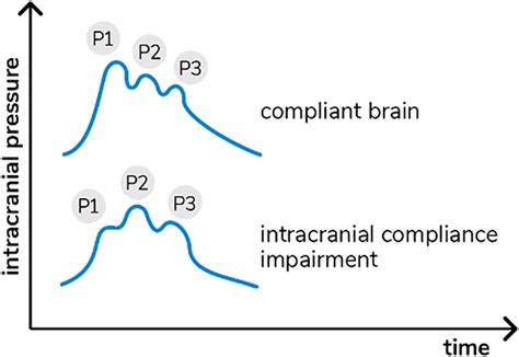 Intracranial Pressure Waves Morphology In Accordance With Cerebral