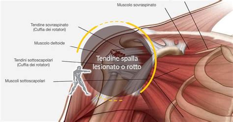 Tendine Spalla Lesionato O Rotto Guida Passo Passo Ryakos Center