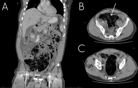 Management Of Sigmoid Perforation From Chronic Constipation And Manual Disimpaction Bmj Case