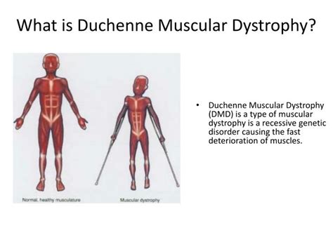 PPT Duchenne Muscular Dystrophy PowerPoint Presentation ID 2211783