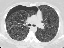 Lymphangioleiomyomatosis