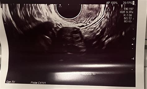 PCOS ultrasound : r/obgyn