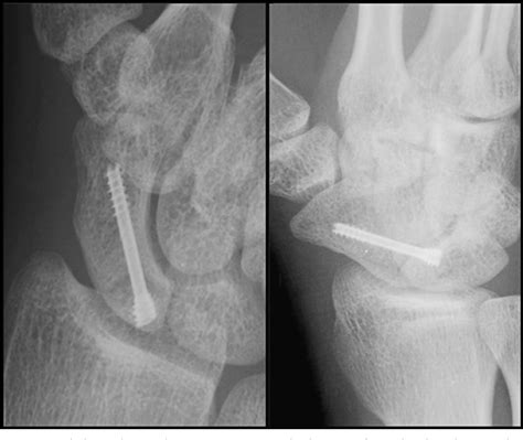 Figure 1 From Minimal Invasive Management Of Scaphoid Fractures From