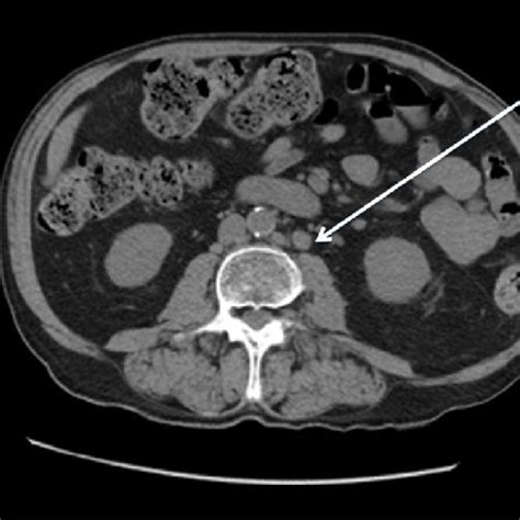 Para Aortic Lymph Nodes Symptoms