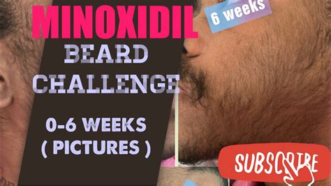 Minoxidil Beard Journey 0 6 Weeks Youtube