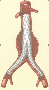 Traitement De L An Vrisme De L Aorte Abdominale Drupal