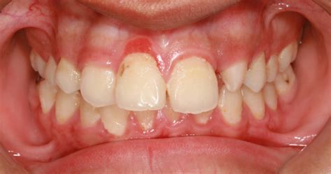 Gingivitis Señales De Alerta Y Cómo Prevenirla Cmo De La Iglesia