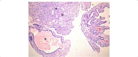 Bladder Nephrogenic Adenoma Displays Structures That Look Like Glands Download Scientific