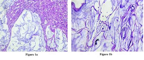 Figure 1 From Colorectal Mucinous Adenocarcinoma In A 30 Year Old