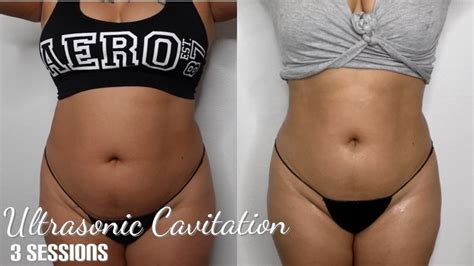 Lipo Before And After Breastfeeding Photos Laser Lipo Mommy Makeover