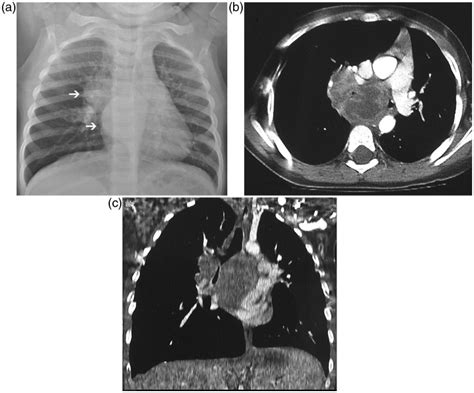 A Posteroanterior Chest X Ray Shows Tuberculosis Manifesting Download Scientific Diagram