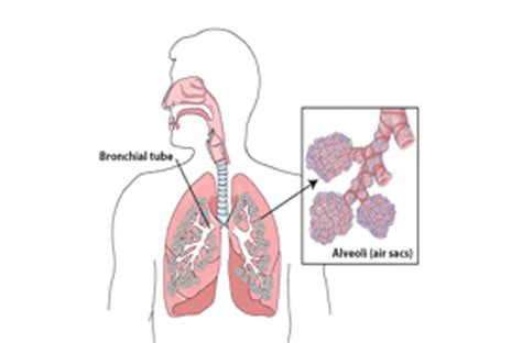 Clrd (Chronic Lower Respiratory Disease)