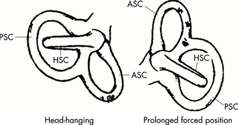 Treatment Of Anterior Canal Benign Paroxysmal Positional Vertigo By A Prolonged Forced Position