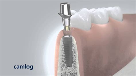 Dental Animation Camlog Implant System Youtube