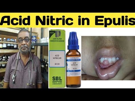 Acid Nitric In Epulis Acid Nitricum 30 200 Use Benefits