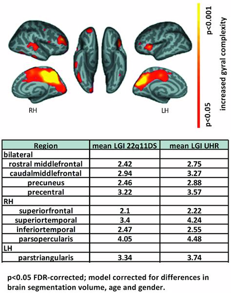 Vertex Wise Comparisons Showing Effect Of Diagnosis On Local