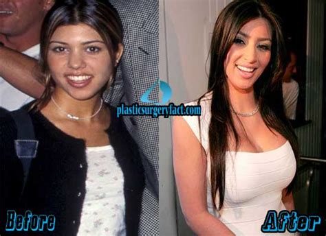 List Of Celebrities With Breast Implants Before And After Pictures