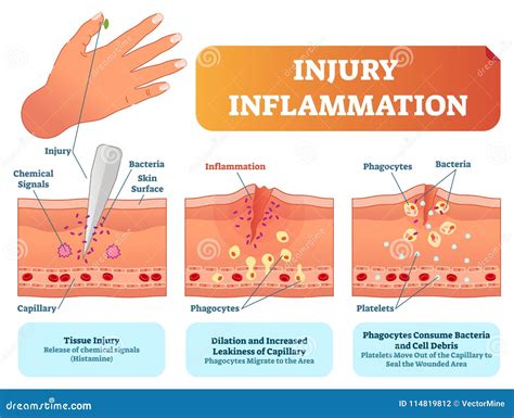 Injury Inflammation Biological Human Body Response Vector Illustration