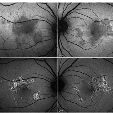 Fundus Autofluorescence Of Acute Posterior Multifocal Placoid Pigment