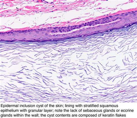 Epidermal Inclusion Cyst Histology