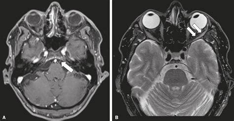 Imaging Of Cranial Nerves A Pictorial Overview Insights Off