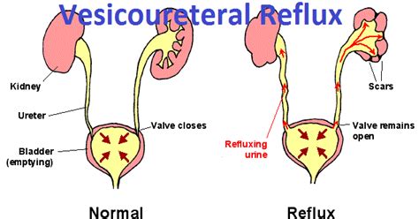 Vesicoureteral Reflux Vur