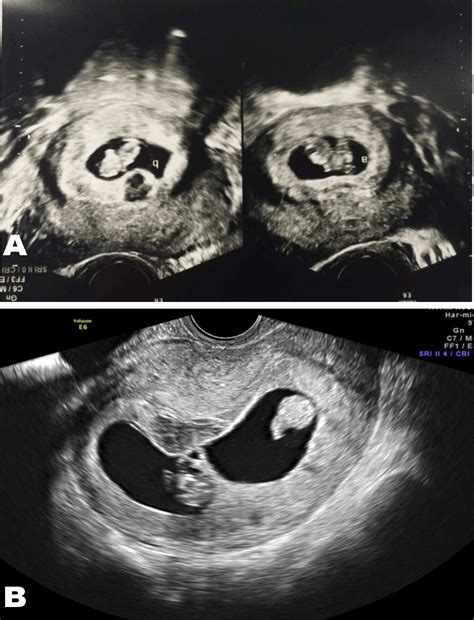 Full Text Spontaneous Heterotopic Triplet Pregnancy Tubal And