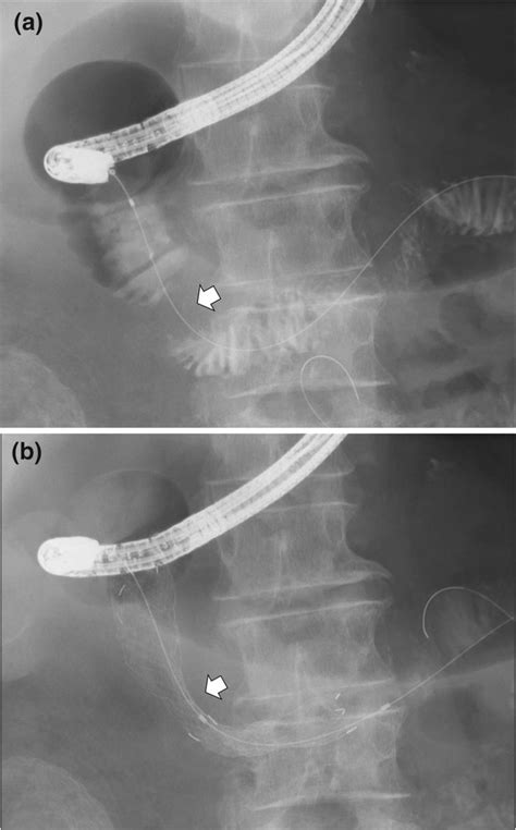 The Process Of Duodenal Stent Placement A A Catheter With A Guidewire Download Scientific