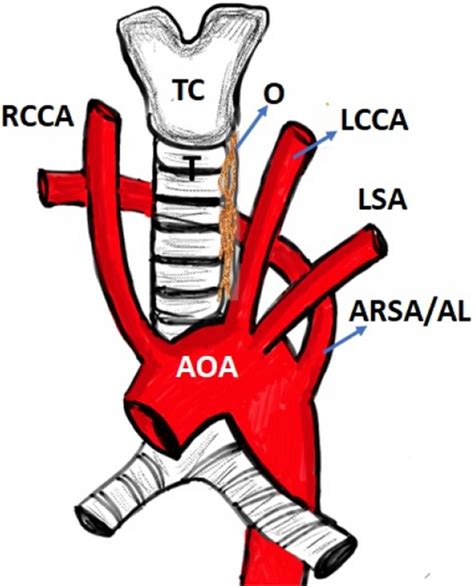 Diagrammatic Representation Of Aberrant Right Subclavian Artery Arsa