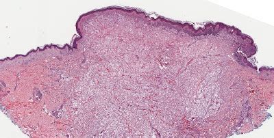 Differential Diagnosis In Dermatopathology Clear Cells