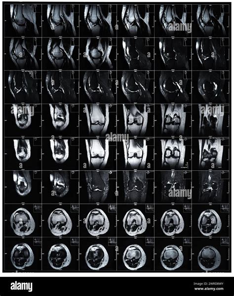 Xray Mri Examination Magnetic Resonance Images Showing Real Fracture