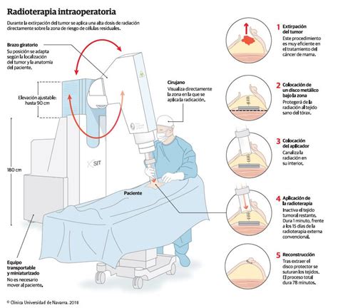 Infográfico Acelerador lineal Radioterapia Clínica Universidad de Navarra