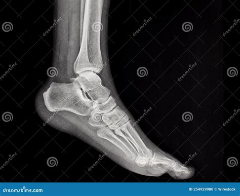 Rayons Du Pied Humain Photo Stock Image Du Anatomie 254929980