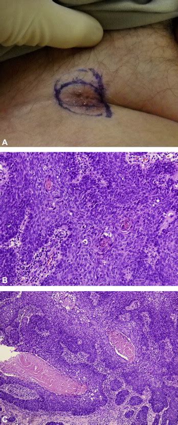 Basaloid Squamous Cell Carcinoma Of The Skin Journal Of The American