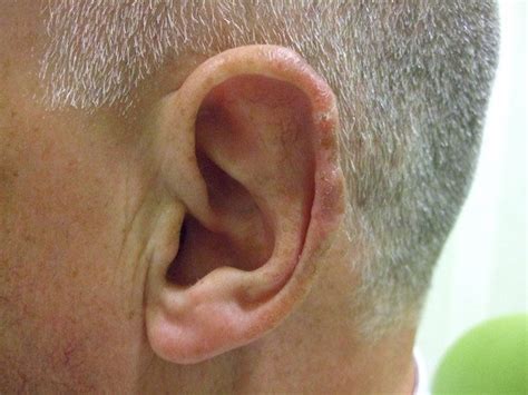 Basal Cell Cancer Of The Rim Of The Ear Dr Vindy Ghura Dermatologist