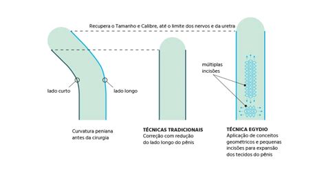 Como Desentortar O Penis